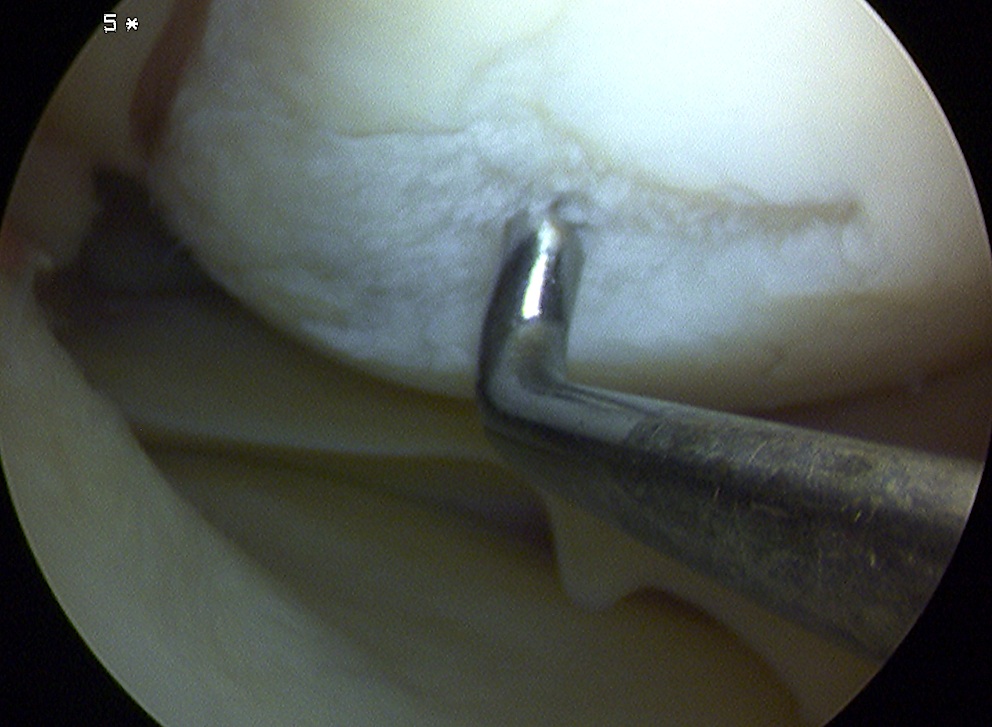 ICRS Grade 3 Chondral Lesion